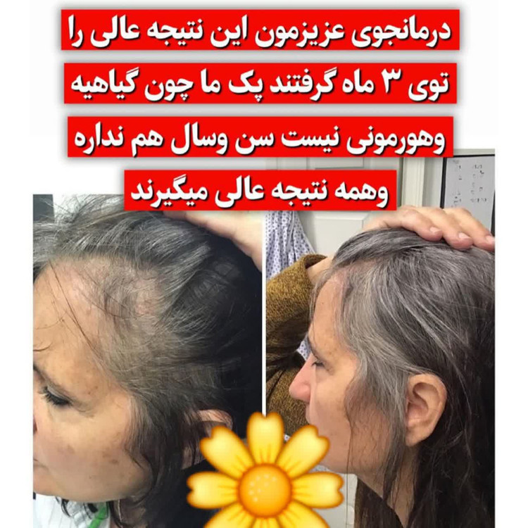 تونیک ضد ریزش و و رویش مجدد مو دوقلو برند اکسونیک(قسطی ۲ عدد)