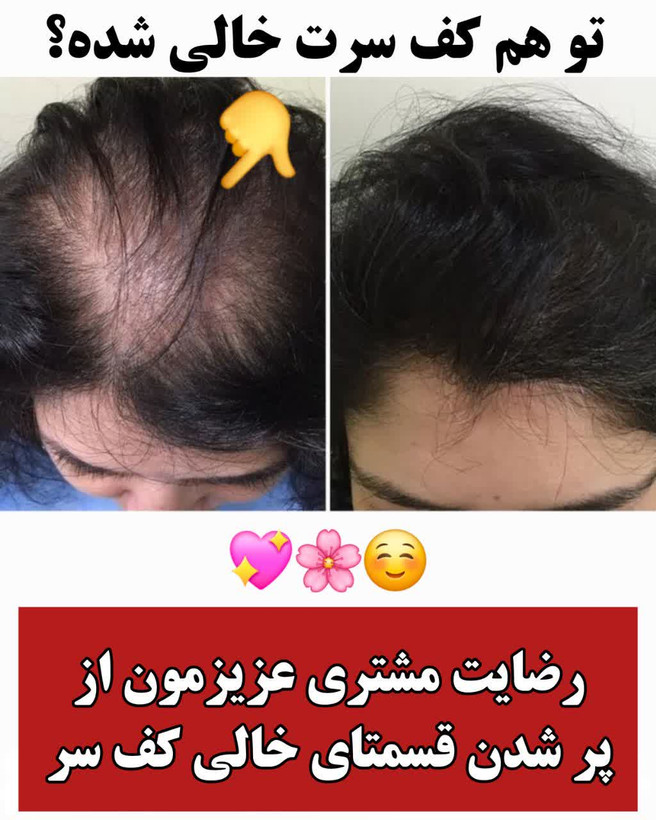 تونیک ضد ریزش و و رویش مجدد مو دوقلو برند اکسونیک(قسطی ۲ عدد)